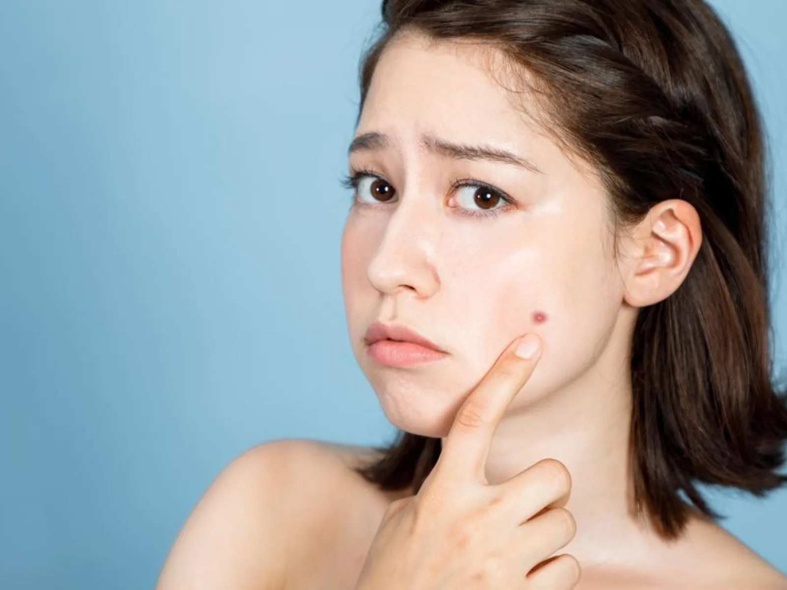 Các nguyên tắc chung giúp kiểm soát và điều trị mụn hiệu quả tại nhà