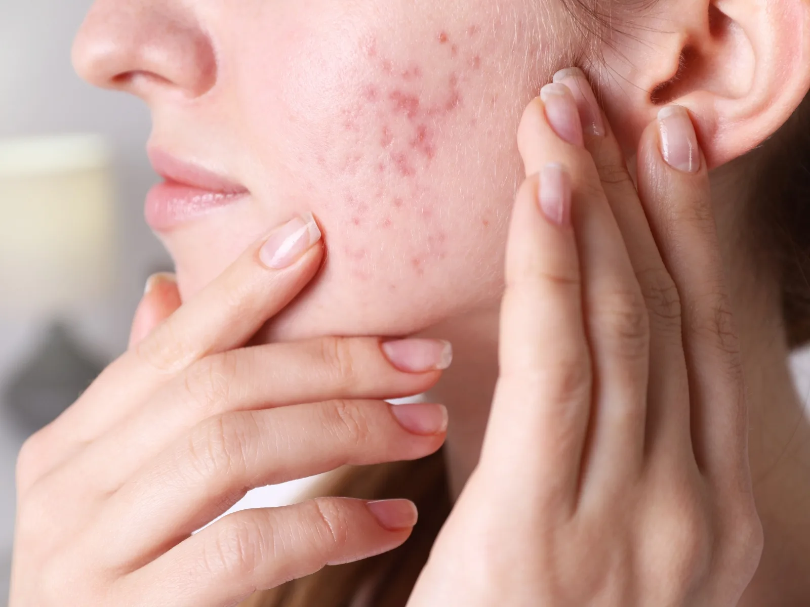 Cách hết mục ở tuổi dậy thì hiệu quả, an toàn và dễ thực hiện tại nhà | FPT Schools